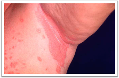 Topical steroid psoriasis